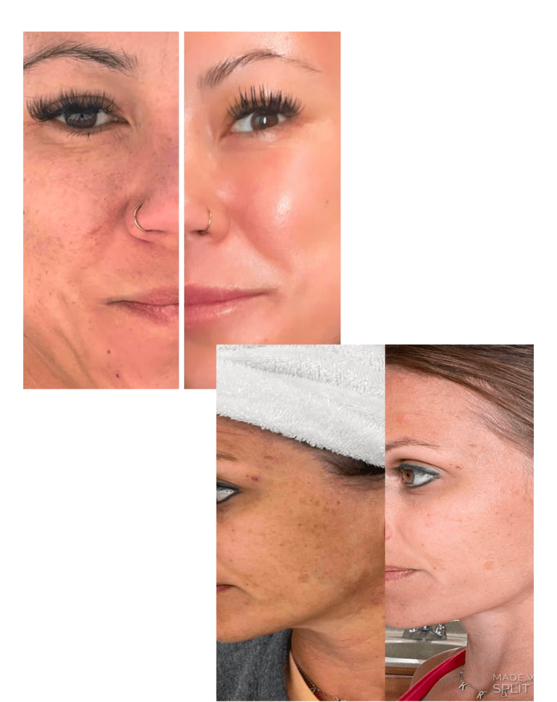 Megan Blinka, Maegan Blinka, HFF, Herbal face foods, Herbal face foods results, organic skin care line, the #1 anti aging skin care line, how to reduce melasma, how to reduce sun spots, how to reduce the signs of aging, organic skin care line, a botox alternative to wrinkle reducing, how to reverse extreme sun damage on your skin, how to cure acne, how to rid the signs of acne scarring, how to get rid of dark circles, how to reduce under eye circles, does HFF work, does herbal face foods actually work, is herbal face foods worth it, why is herbal face foods so expensive